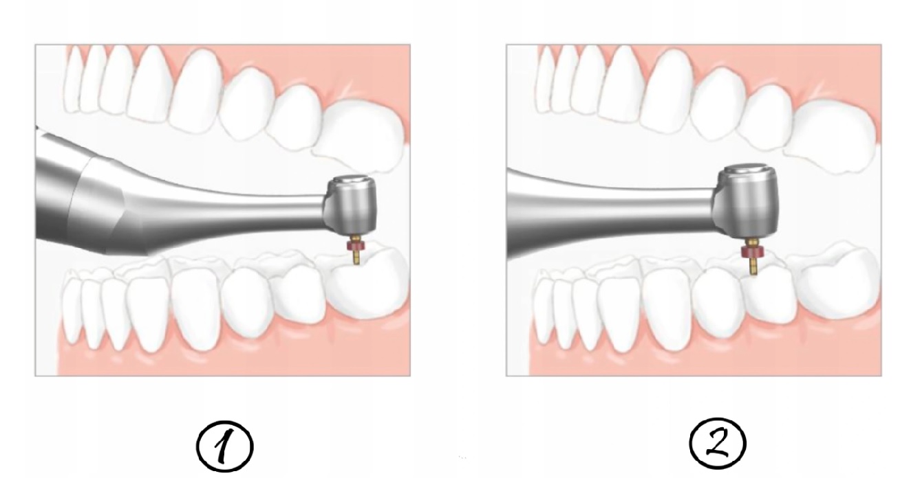 Woodpecker mikrosilnik endodontyczny MOTOPEX z endometrem - obrazek 5